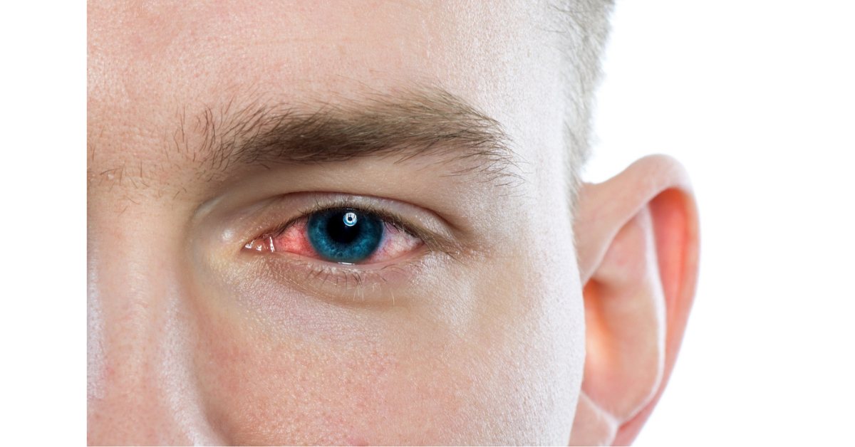 What is Commonly Misdiagnosed as Pink Eye